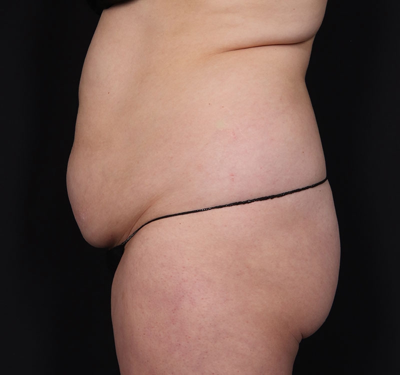 New Jersey Monsplasty Before & After Gallery - Patient 241969 - Image 5