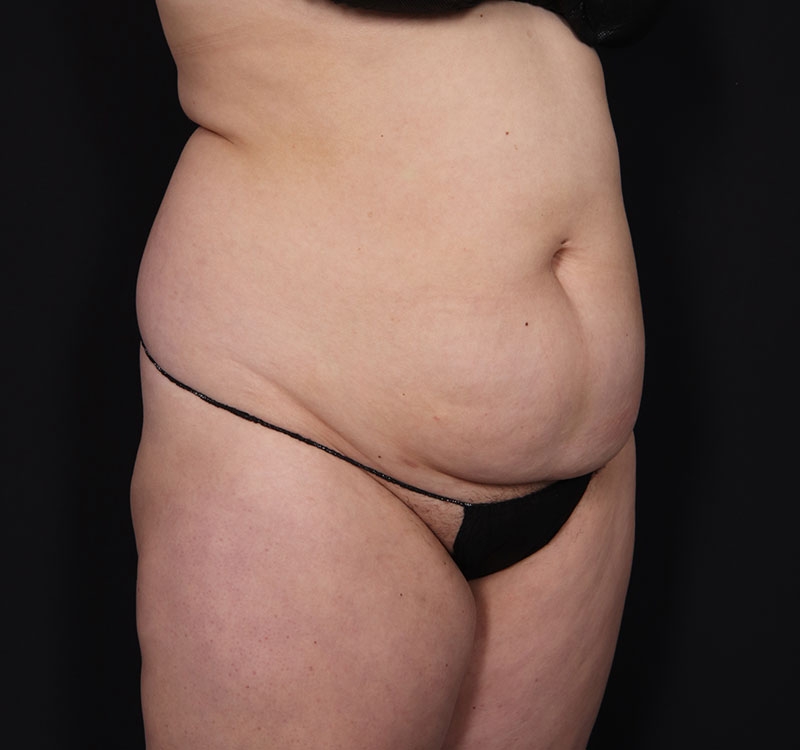 New Jersey Monsplasty Before & After Gallery - Patient 241969 - Image 9