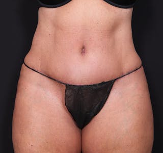 New Jersey Monsplasty Before & After Gallery - Patient 241792 - Image 2