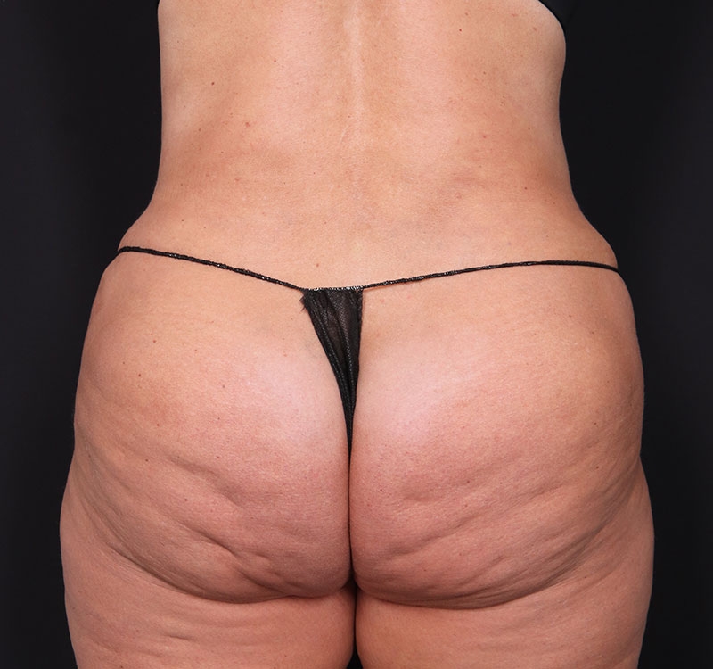 New Jersey Monsplasty Before & After Gallery - Patient 241792 - Image 6