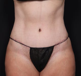 New Jersey Monsplasty Before & After Gallery - Patient 344610 - Image 2