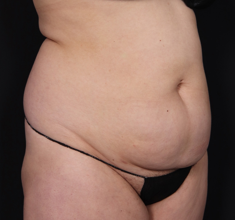 New Jersey Monsplasty Before & After Gallery - Patient 348499 - Image 3