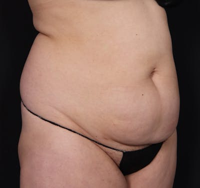 New Jersey Monsplasty Before & After Gallery - Patient 348499 - Image 3