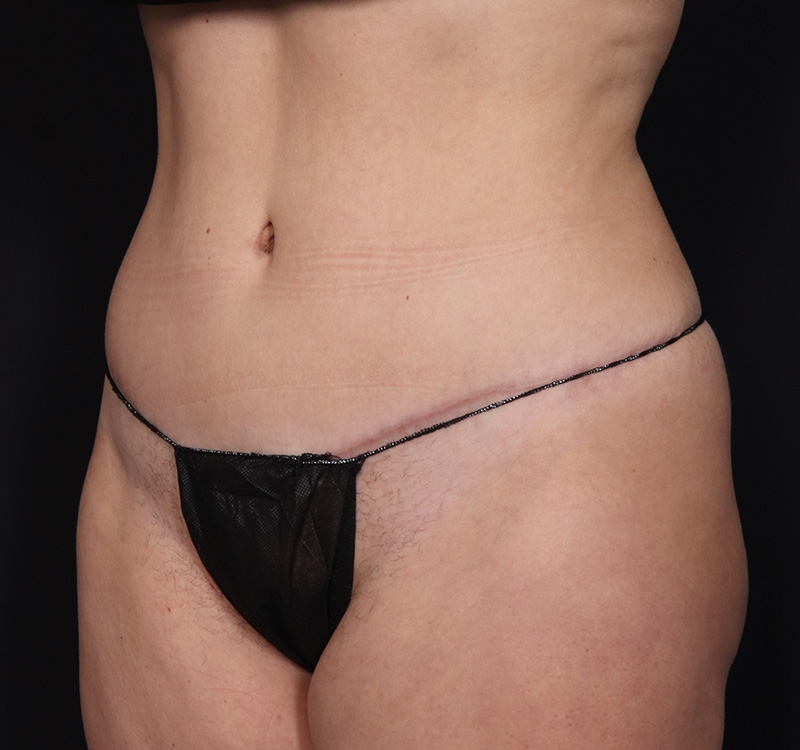 New Jersey Monsplasty Before & After Gallery - Patient 348499 - Image 6