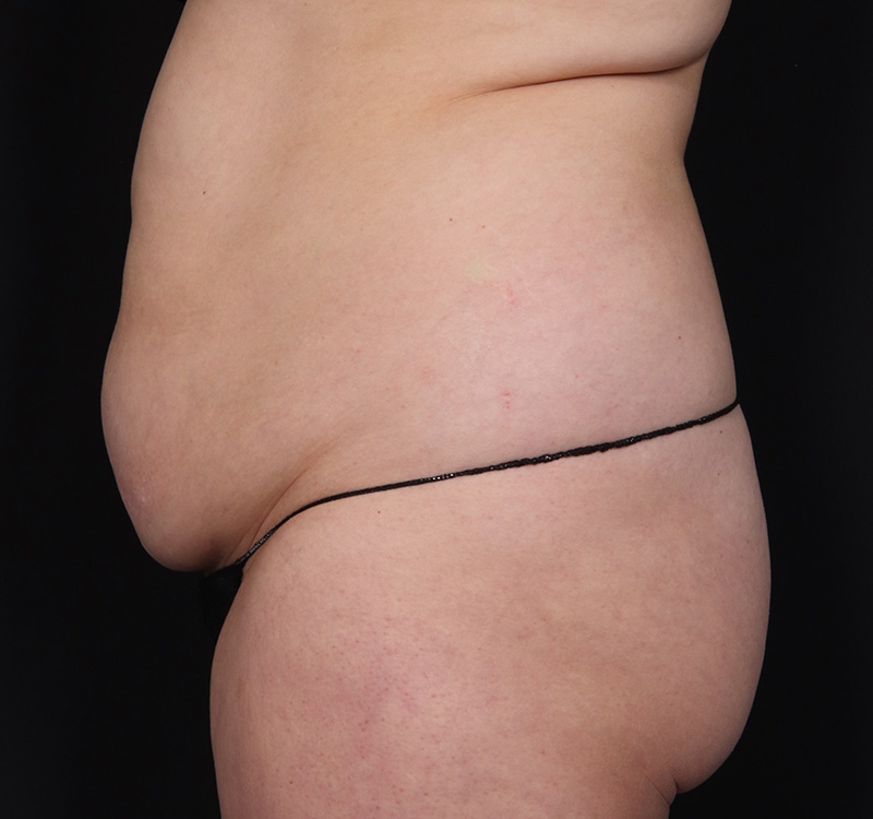 New Jersey Monsplasty Before & After Gallery - Patient 348499 - Image 7