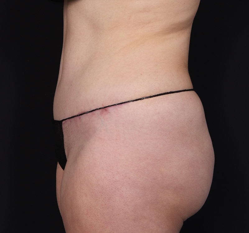 New Jersey Monsplasty Before & After Gallery - Patient 348499 - Image 8