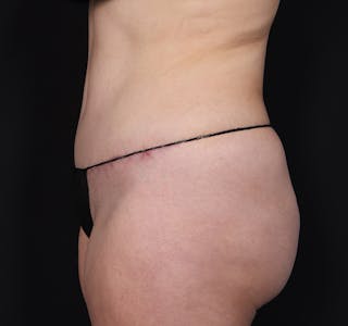 New Jersey Monsplasty Before & After Gallery - Patient 348499 - Image 8