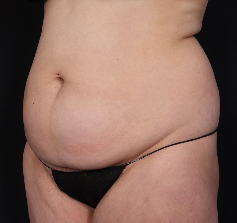 New Jersey Monsplasty Before & After Gallery - Patient 348499 - Image 5