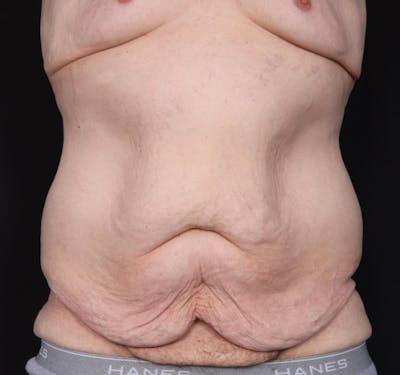 New Jersey Body Lift Before & After Gallery - Patient 311180 - Image 1