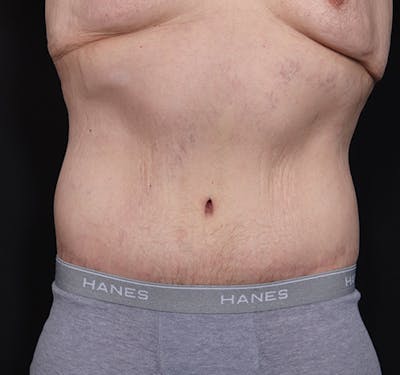New Jersey Body Lift Before & After Gallery - Patient 311180 - Image 2
