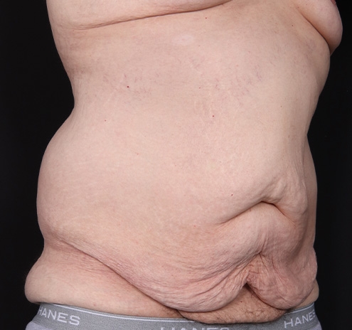 New Jersey Body Lift Before & After Gallery - Patient 311180 - Image 3