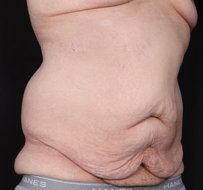New Jersey Body Lift Before & After Gallery - Patient 311180 - Image 3
