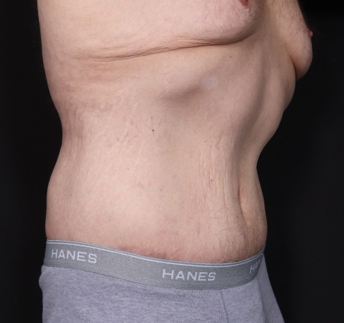 New Jersey Body Lift Before & After Gallery - Patient 311180 - Image 4