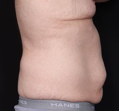 New Jersey Body Lift Before & After Gallery - Patient 311180 - Image 5