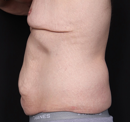 New Jersey Body Lift Before & After Gallery - Patient 311180 - Image 7