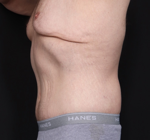 New Jersey Body Lift Before & After Gallery - Patient 311180 - Image 8
