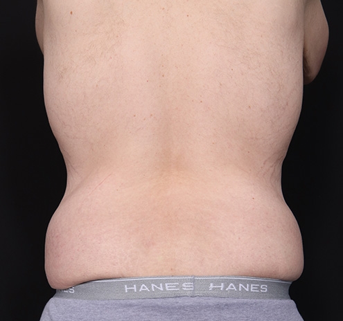 New Jersey Body Lift Before & After Gallery - Patient 311180 - Image 9