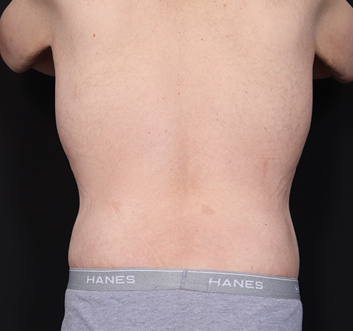 New Jersey Body Lift Before & After Gallery - Patient 311180 - Image 10
