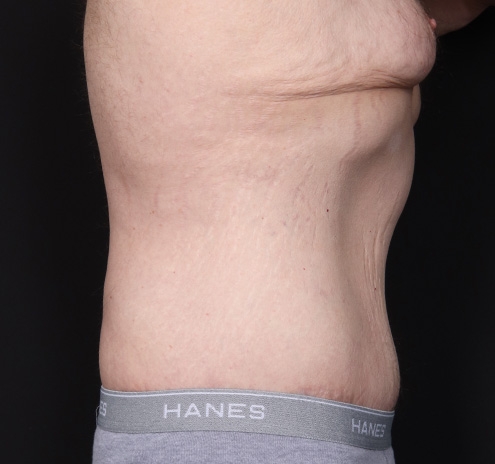 New Jersey Body Lift Before & After Gallery - Patient 311180 - Image 6