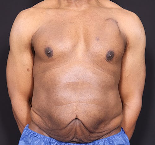 New Jersey Body Lift Before & After Gallery - Patient Bn3QwzO4RnmO2YQVE61acw - Image 1