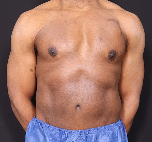 New Jersey Body Lift Before & After Gallery - Patient 380842 - Image 2
