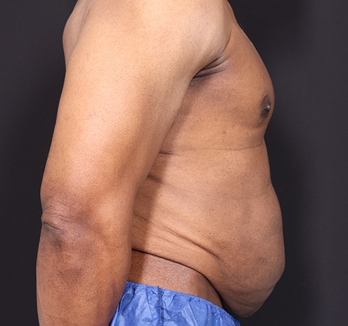 New Jersey Body Lift Before & After Gallery - Patient 380842 - Image 5