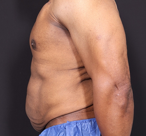 New Jersey Body Lift Before & After Gallery - Patient 380842 - Image 7
