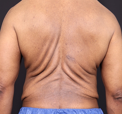 New Jersey Body Lift Before & After Gallery - Patient 380842 - Image 9