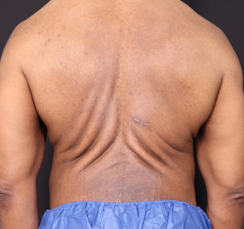 New Jersey Body Lift Before & After Gallery - Patient 380842 - Image 10