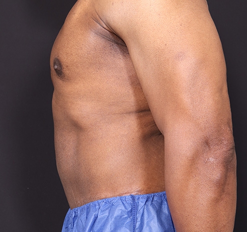 New Jersey Body Lift Before & After Gallery - Patient 380842 - Image 8