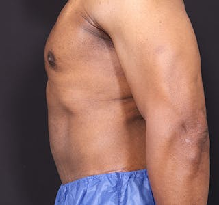 New Jersey Body Lift Before & After Gallery - Patient 380842 - Image 8