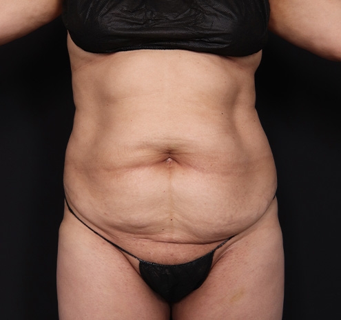 New Jersey Tummy Tuck Before & After Gallery - Patient 294876 - Image 1