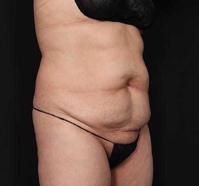 New Jersey Liposuction Before & After Gallery - Patient 55432683 - Image 3