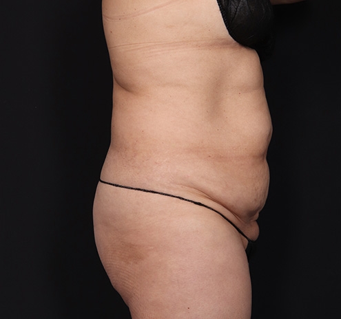 New Jersey Tummy Tuck Before & After Gallery - Patient 294876 - Image 5