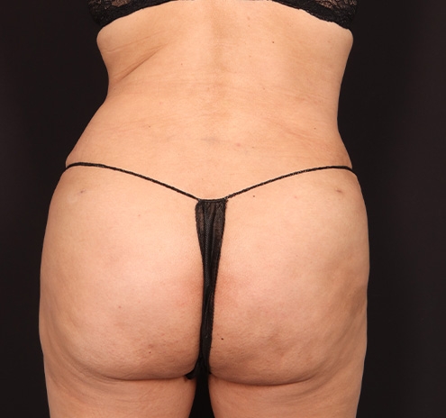 New Jersey Tummy Tuck Before & After Gallery - Patient 294876 - Image 10