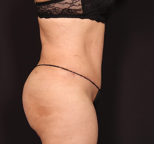 New Jersey Tummy Tuck Before & After Gallery - Patient 294876 - Image 6