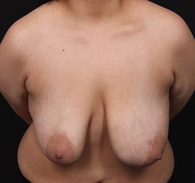 New Jersey Breast Reduction Before & After Gallery - Patient 142449 - Image 3