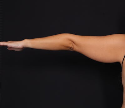 New Jersey Bodytite Before & After Gallery - Patient 401086 - Image 3