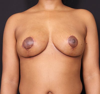 New Jersey Breast Lift (Mastopexy) Before & After Gallery - Patient 537841 - Image 2