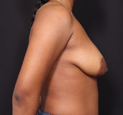New Jersey Breast Lift (Mastopexy) Before & After Gallery - Patient 537841 - Image 5