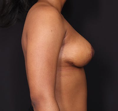 New Jersey Breast Lift (Mastopexy) Before & After Gallery - Patient 537841 - Image 6
