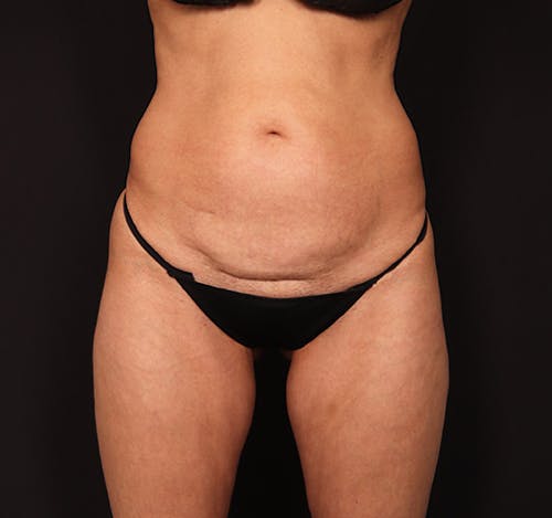 New Jersey Tummy Tuck Before & After Gallery - Patient FnaHiwV5R22OnFb_McXCgA - Image 1