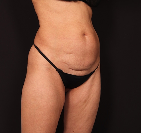 New Jersey Tummy Tuck Before & After Gallery - Patient 246609 - Image 3