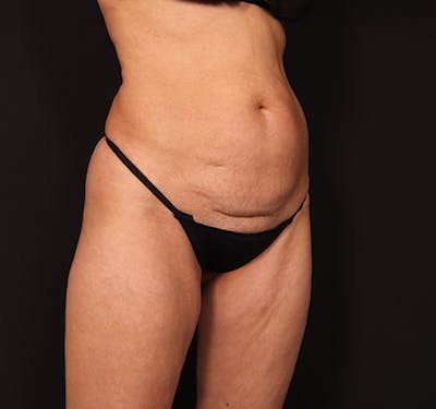 New Jersey Liposuction Before & After Gallery - Patient 402520 - Image 3