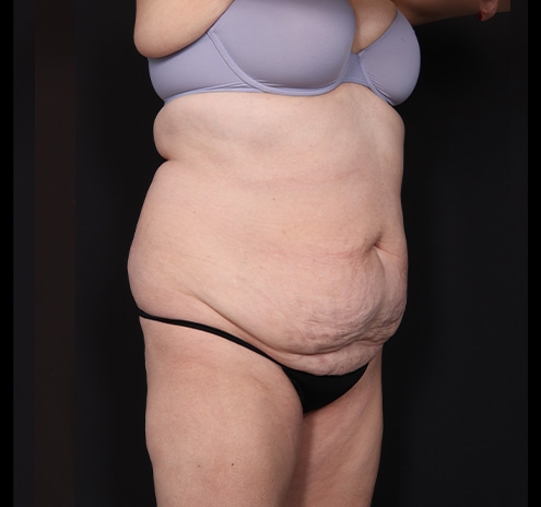 New Jersey Tummy Tuck Before & After Gallery - Patient 198833 - Image 3