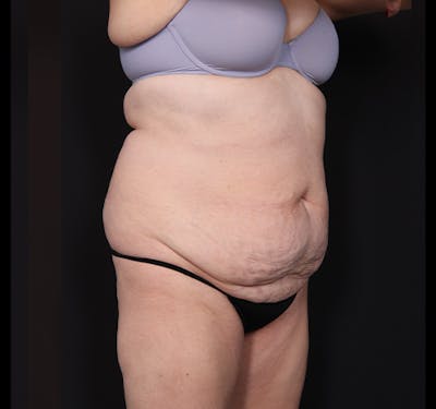 New Jersey Liposuction Before & After Gallery - Patient 385591 - Image 3