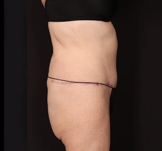 New Jersey Tummy Tuck Before & After Gallery - Patient 198833 - Image 6
