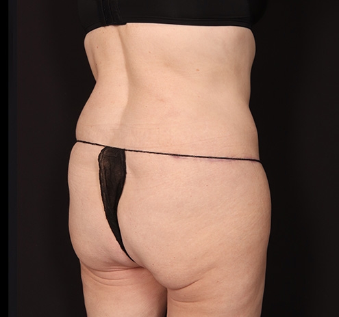 New Jersey Tummy Tuck Before & After Gallery - Patient 198833 - Image 8