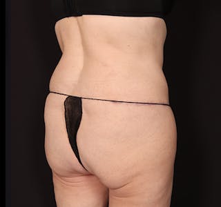 New Jersey Tummy Tuck Before & After Gallery - Patient 198833 - Image 8
