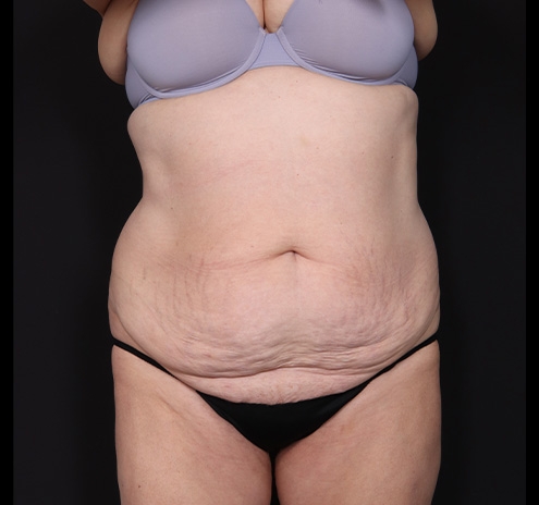 New Jersey Tummy Tuck Before & After Gallery - Patient 198833 - Image 1